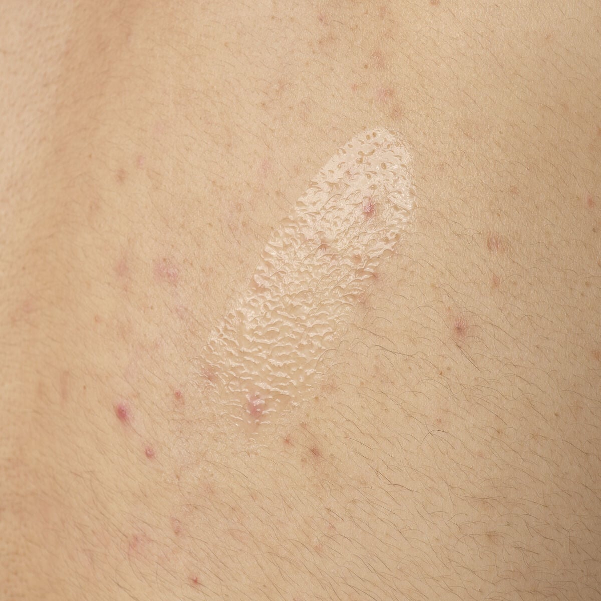 salicylic-acid-0-5-body-serum-i3 ORD-salicylic-acid-05-body-240ml-application.jpg