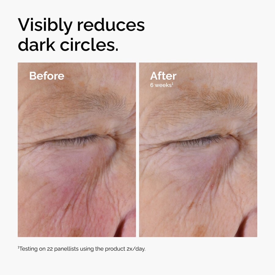 caffeine-solution-5-egcg-eye-serum-b3 ord-caffeine-solution-egcg-dark-circles-before-after.jpg