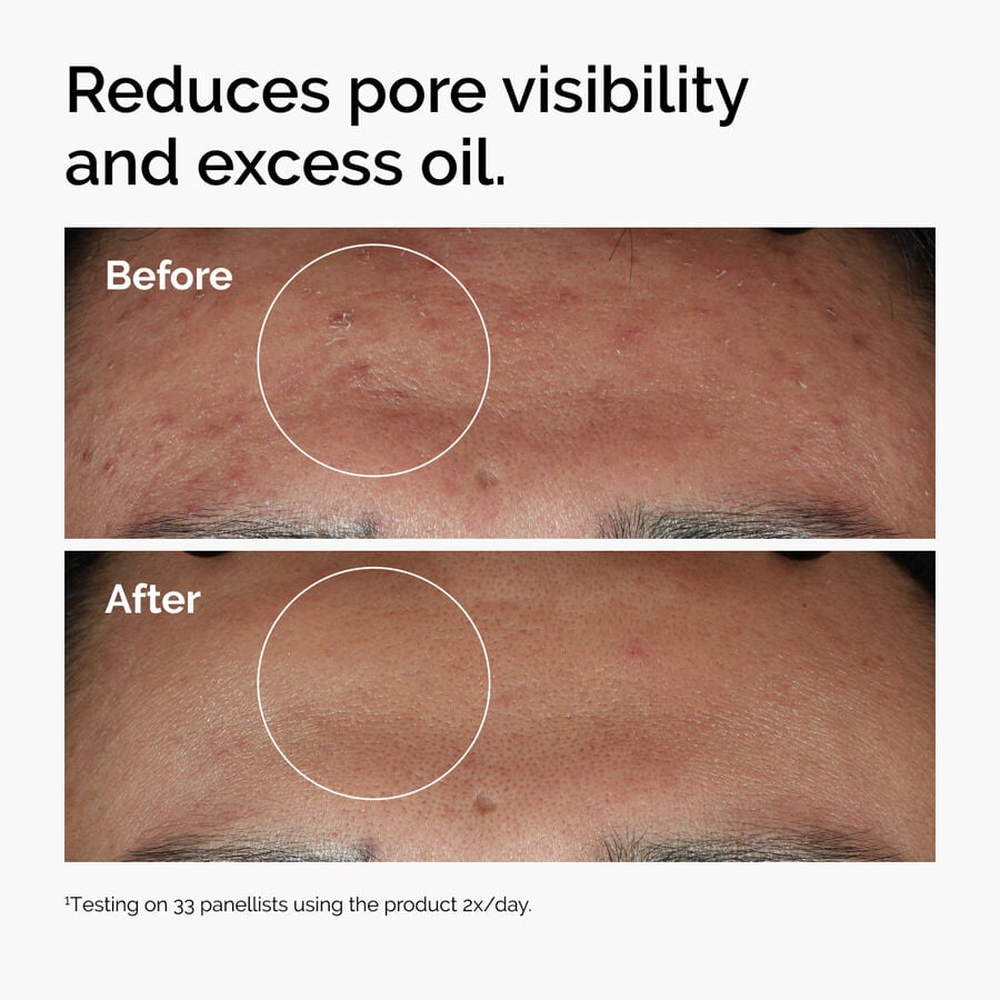 niacinamide-10-zinc-1-d3 ord-niacinamide-zinc-blemish-serum-before-after-pores.jpg