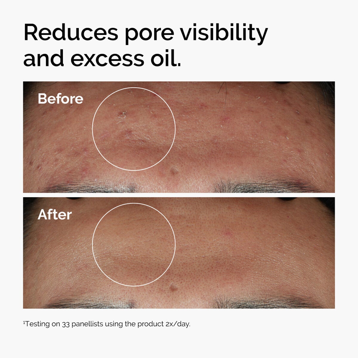 niacinamide-10-zinc-1-d3 ord-niacinamide-zinc-blemish-serum-before-after-pores.jpg