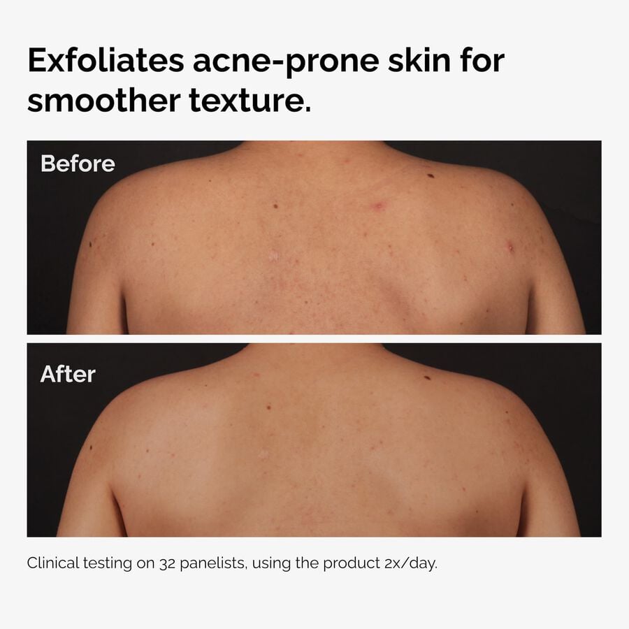 the-body-care-collection-o0 ord-salicylic-acid-body-serum-before-after-graphic-NA.jpg