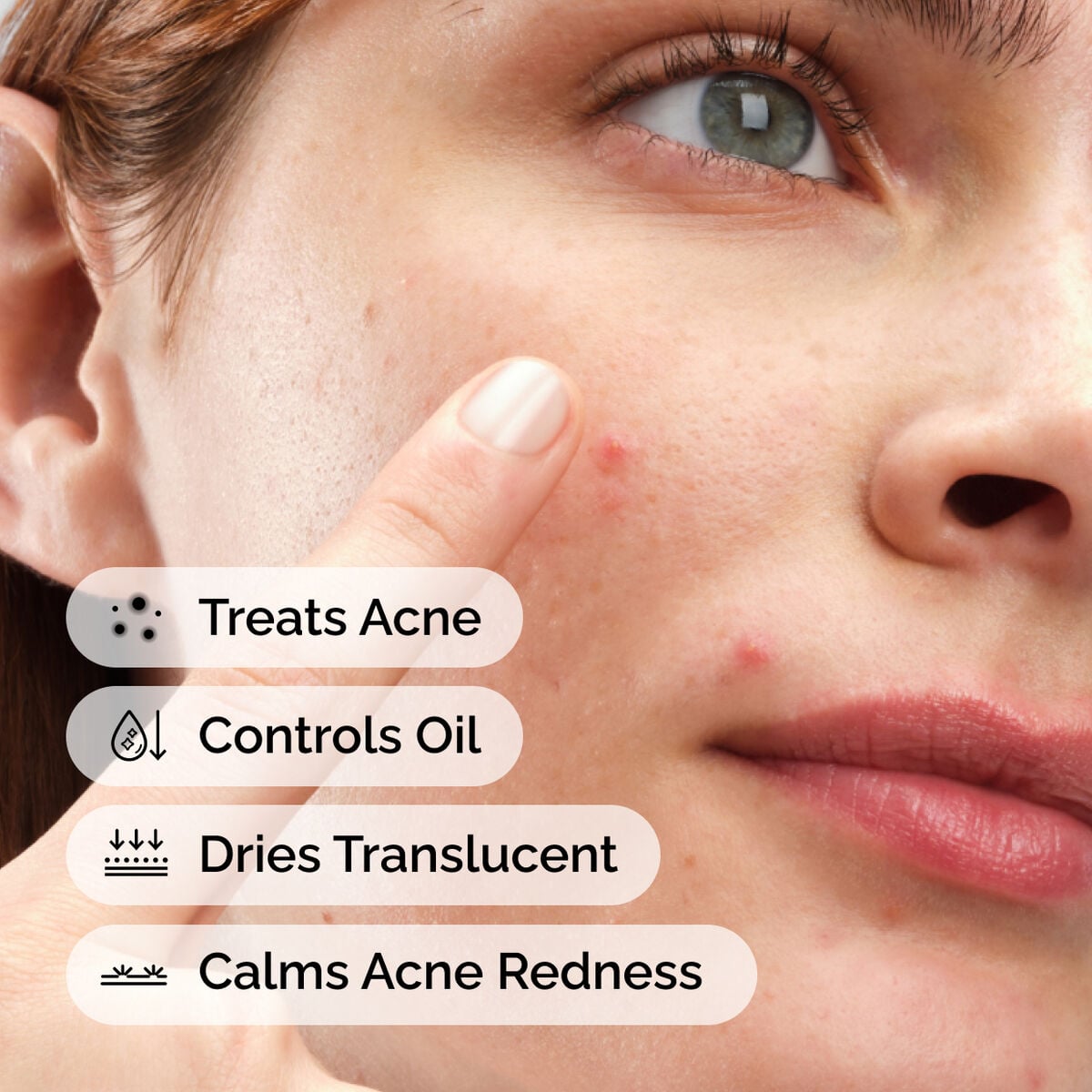 sulfur-10-powder-to-cream-concentrate-e7 ord-sulfur-10pct-powder-to-cream-concentrate-model-application-with-benefits-acne.jpg