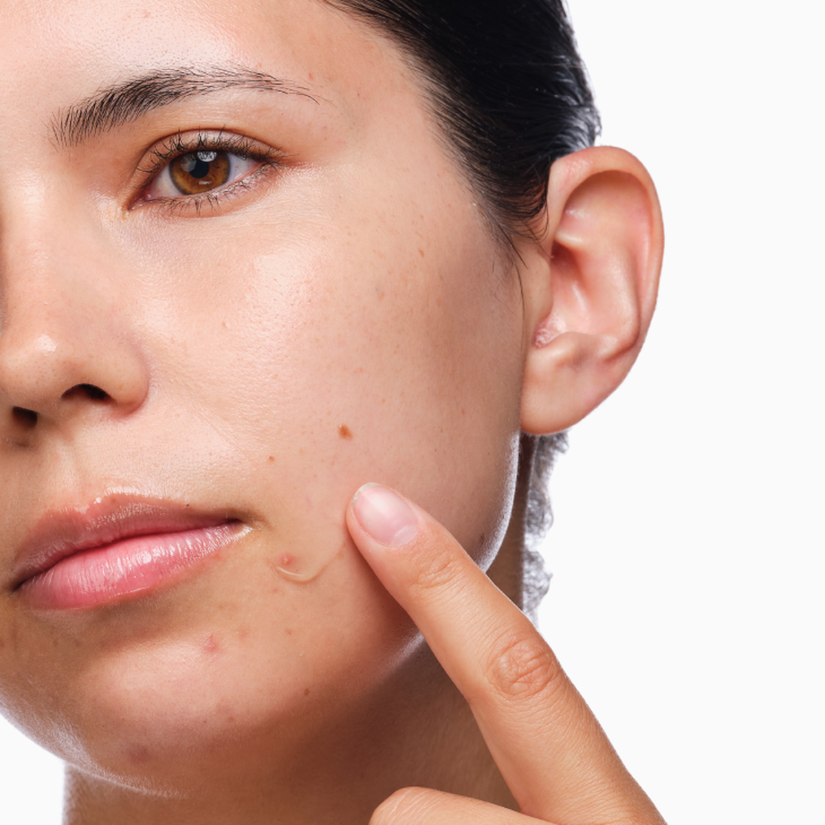 the-acne-set-x0 rdn-the-acne-set-application.png